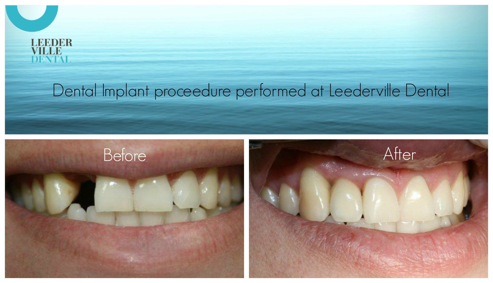 leederville-dental-dental-implants
