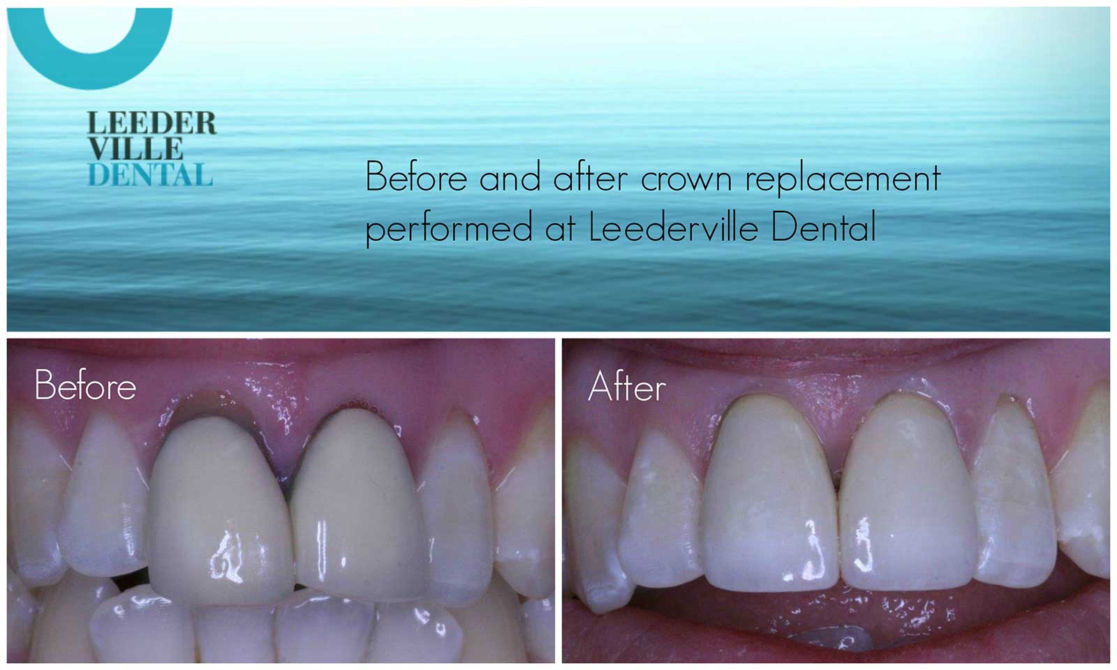 leederville-dental-gallery-03-crown-replacement