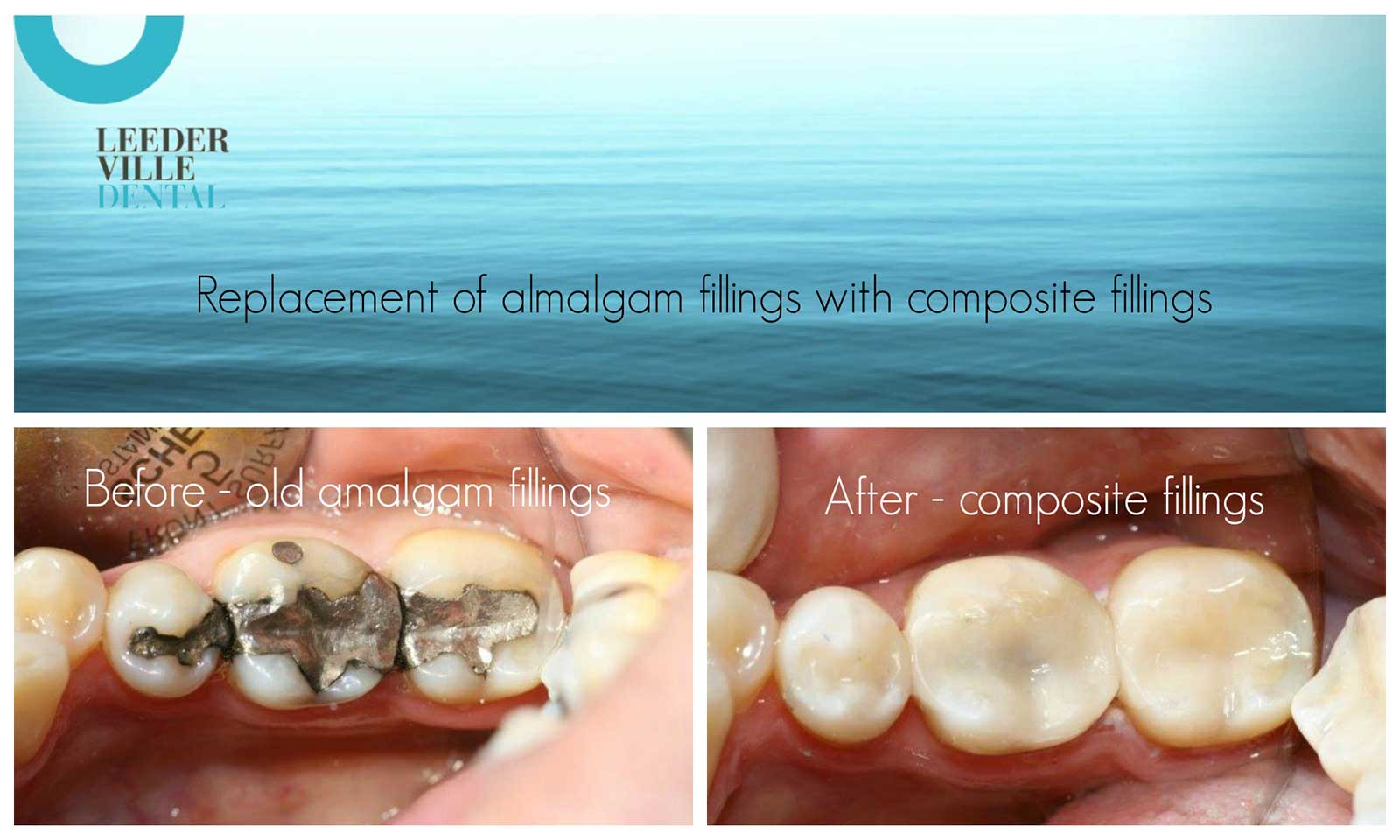 leederville-dental-gallery-05-composite-fillings