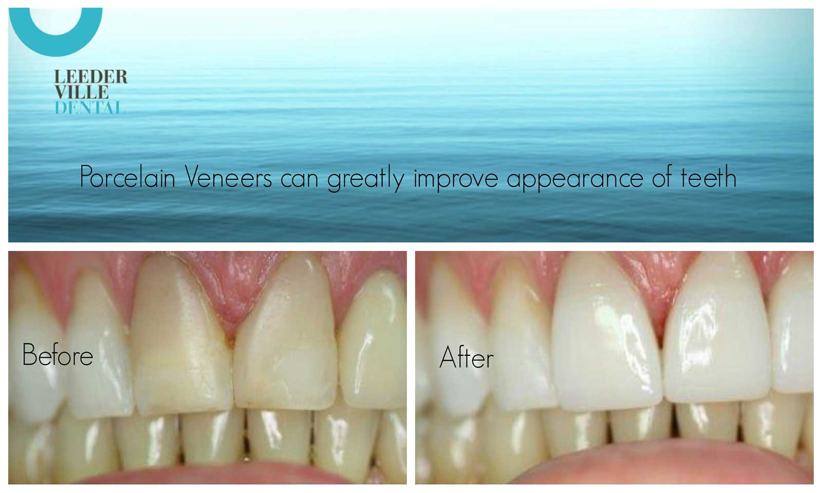 leederville-dental-gallery-06-porcelain-veneers