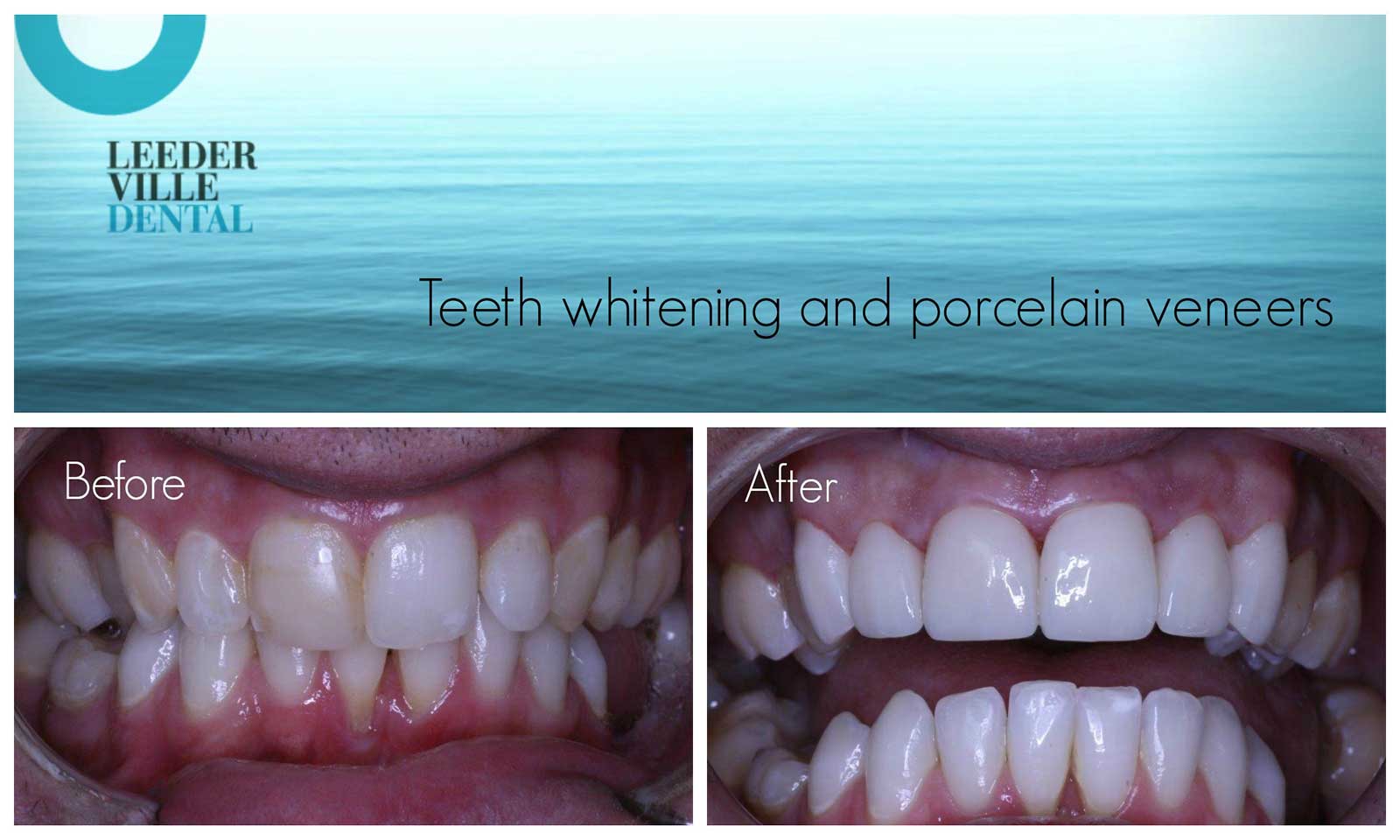 leederville-dental-gallery-07-teeth-whitening