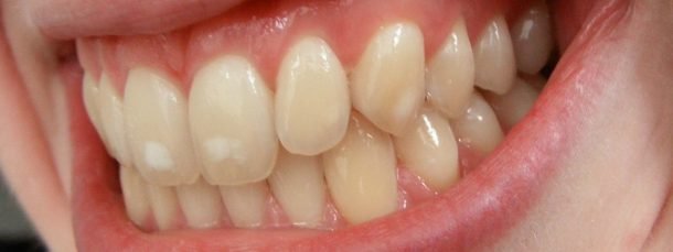 Fluorosis on teeth
