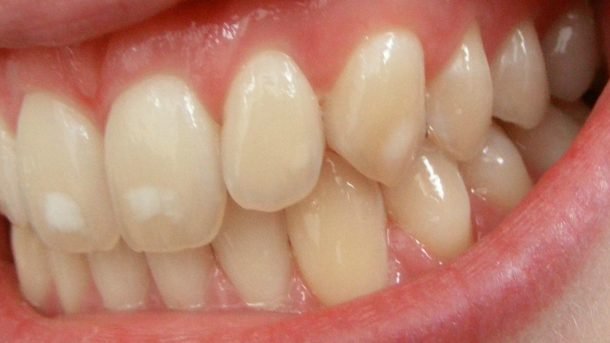 Fluorosis on teeth