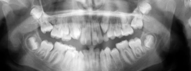 impacted wisdom teeth on teenager