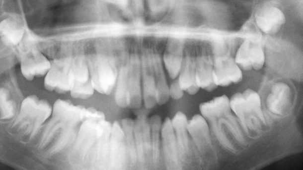 impacted wisdom teeth on teenager