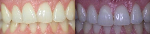 Dentist teeth whitening in Perth