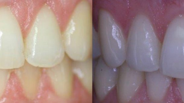 Dentist teeth whitening in Perth