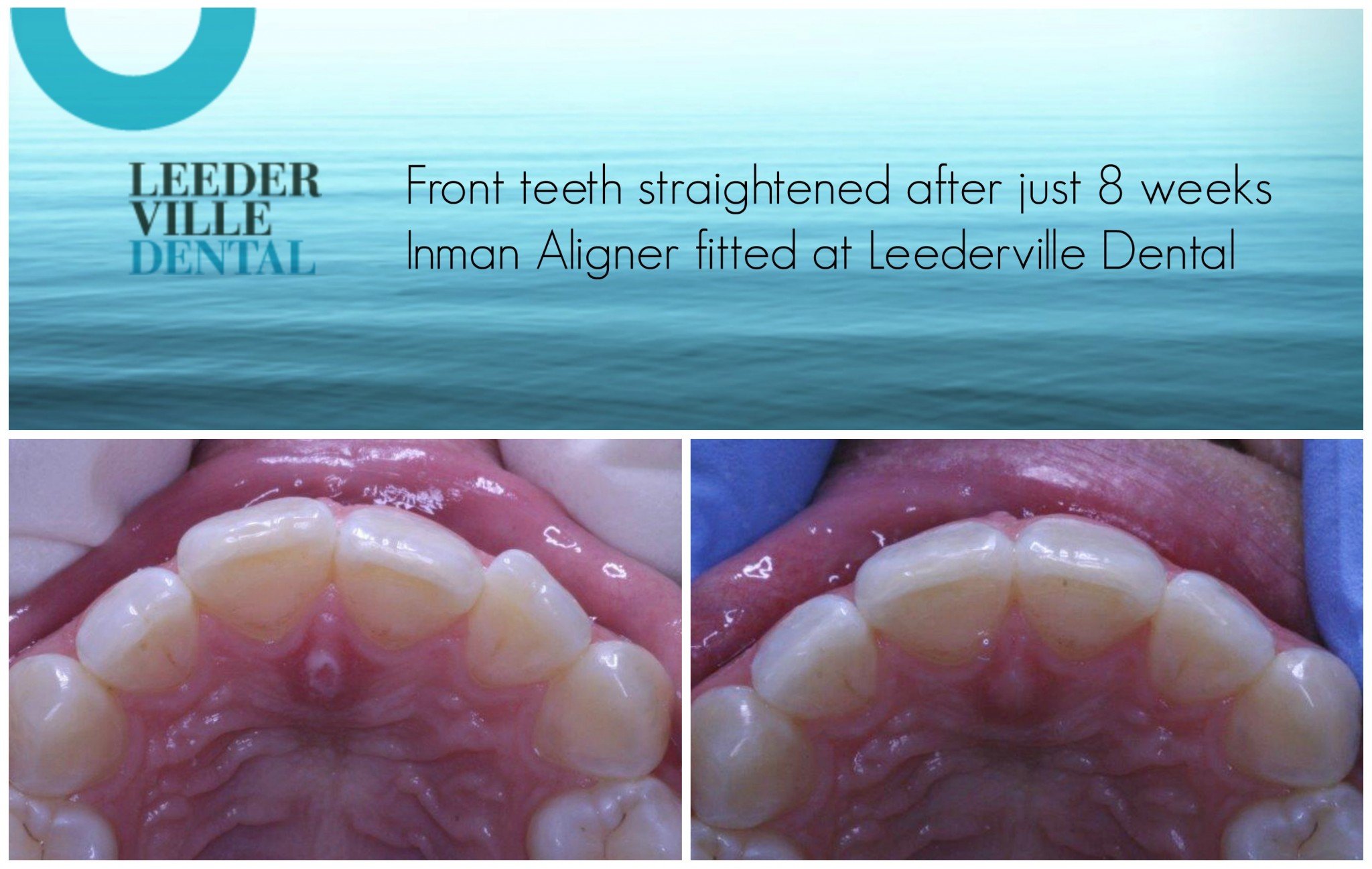 front teeth straigthened after 8 weeks