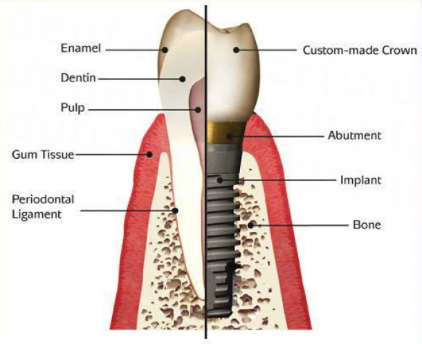 titanium implant with zirconium crown