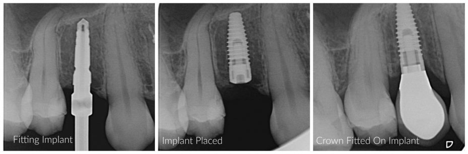 stages of tooth implant procedure