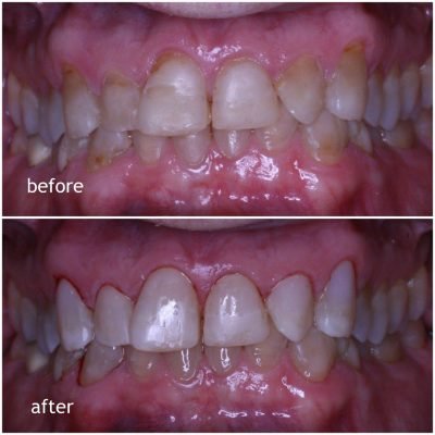Composite Bonding to Repair Teeth