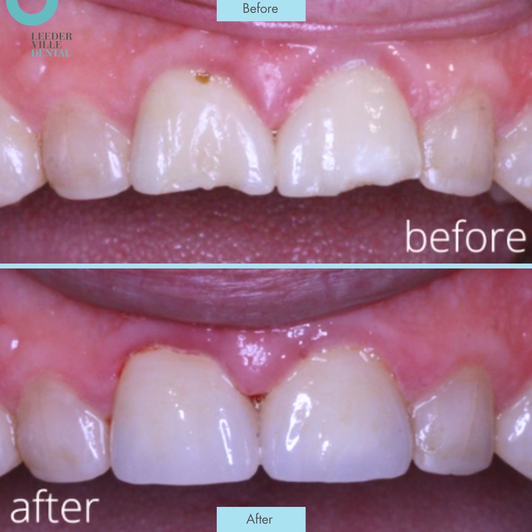 Crown replacement Leederville Dental Post (3)