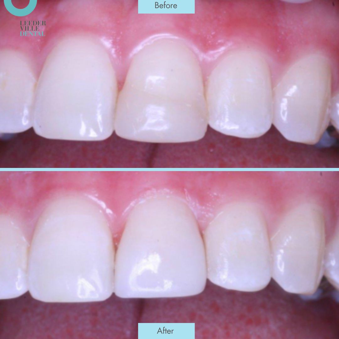 Crown replacement Leederville Dental Post (4)