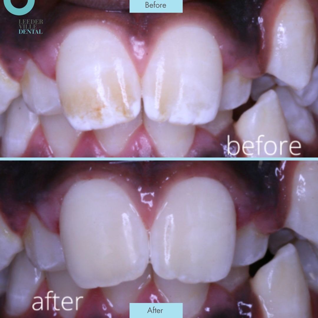 Flurosis Leederville Dental Post