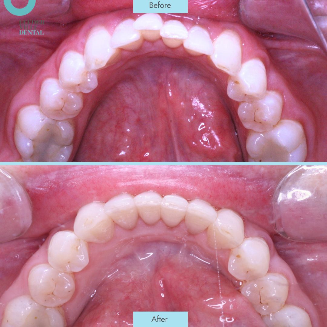 sile true Leederville Dental Post (3)