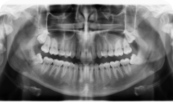 Wisdom Teeth Removal Mt Hawthorn