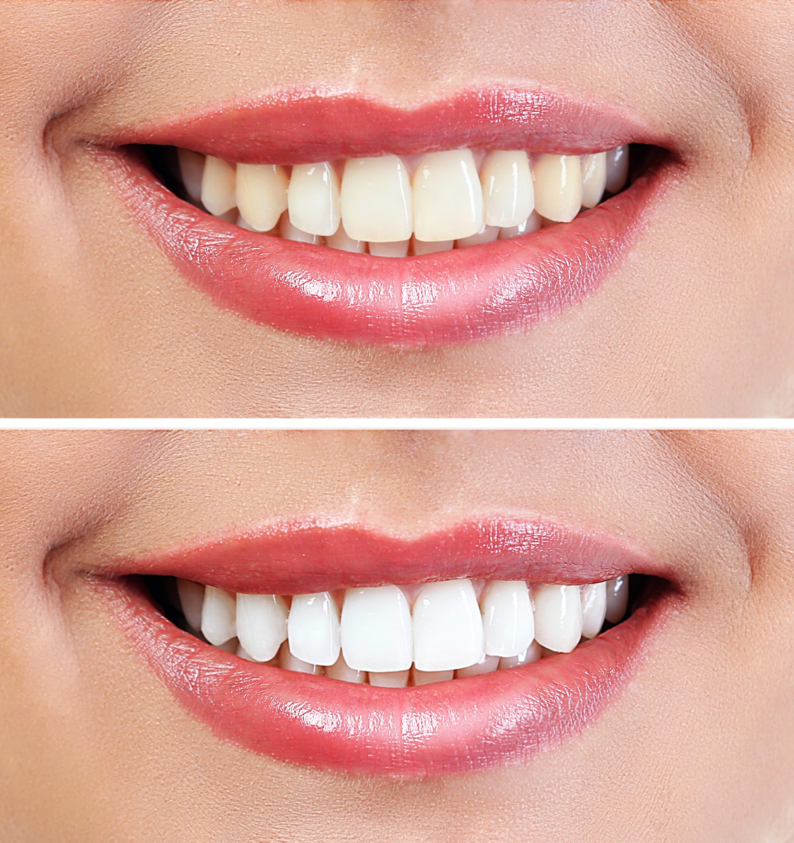 teeth whitening before and after
