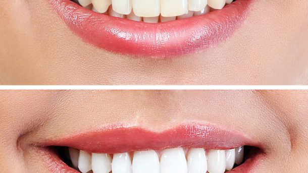 teeth whitening before and after