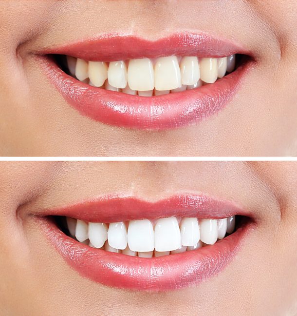 teeth whitening before and after