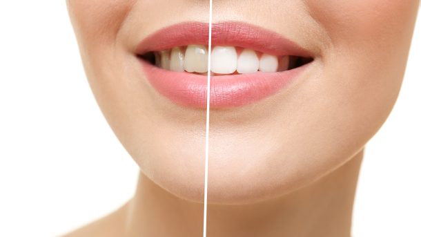 how expensive is teeth whitening
