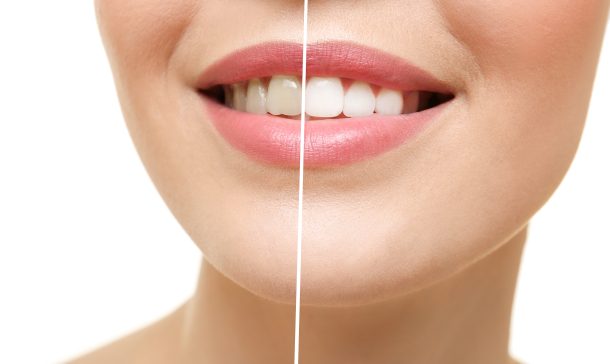 how expensive is teeth whitening