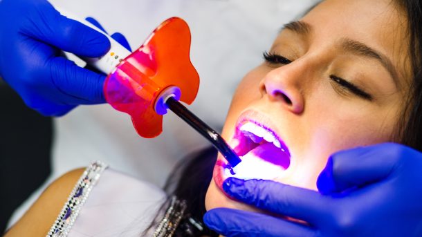 laser teeth whitening