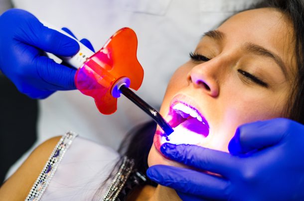 laser teeth whitening